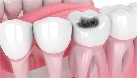 Best Treatment Options For Dental Cavities Vistadent