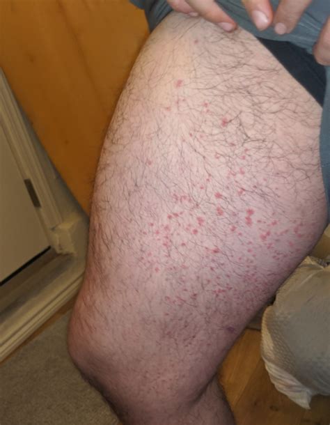 Flat Red Spots On Legs Dermatology Forums Patient