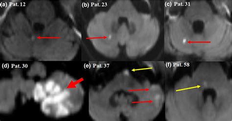 Diffusionweighted Magnetic Resonance Imaging Showing Examples Of Download Scientific Diagram