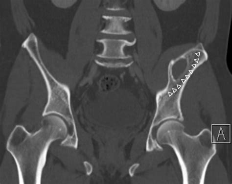 Chronic Subperiosteal Hematoma Of The Iliac Bone Eurorad