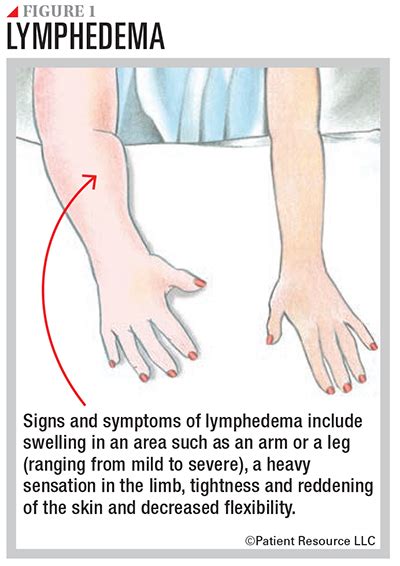 Side Effects Lymphedema