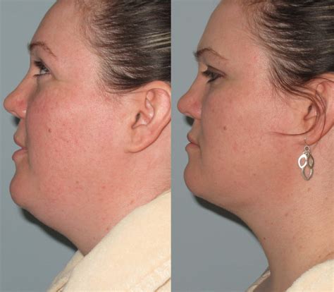 Double Chin Radio Frequency Liposuction Double Chin Liposuction By Llv
