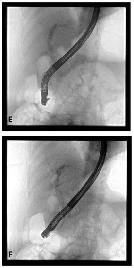 Gastroenterology Insights Free Full Text Troubleshooting Difficult