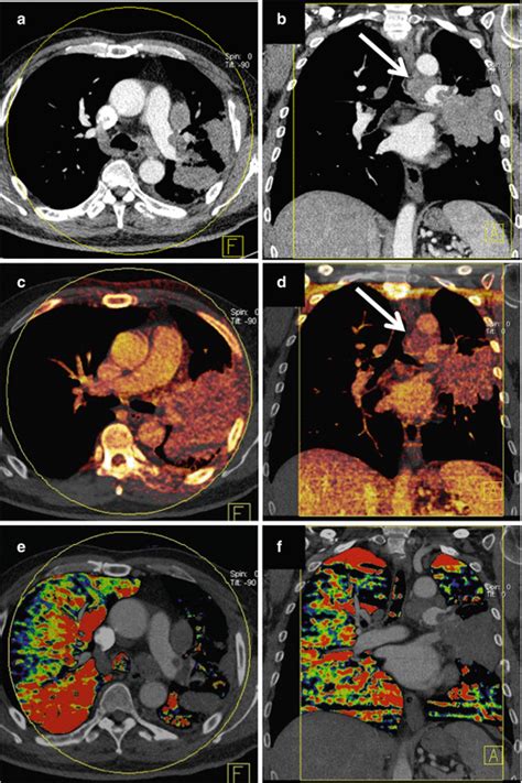 Dual Energy Ct In Chest Tumors Oncohema Key