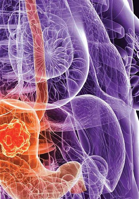 Imaging Findings Of Gastric Carcinoma Intechopen