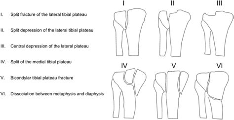 The Schatzker Classification Of Tibial Plateau Fractures Depicted Is