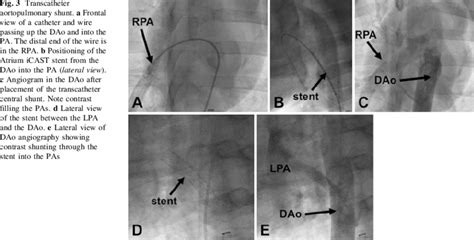 Transcatheter Aortopulmonary Shunt A Frontal View Of A Catheter And