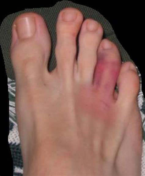 Healthool Sprained Toe Symptoms Vs Broken Big Toe