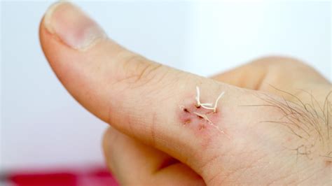 Let us know how we can help! What Should You Do If Dissolvable Stitches Don't Dissolve ...