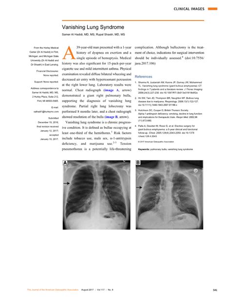 PDF Vanishing Lung Syndrome
