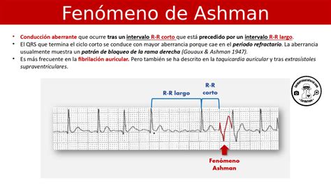Cardiotruco Fenómeno De Ashman Cardioprimaria Ferrol