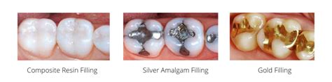 Dental Fillings For Cavities Advanced Dental Arts