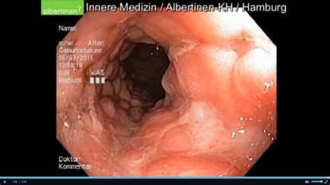 Colitis ulcerosa - Symptome und Bilder | Medumio