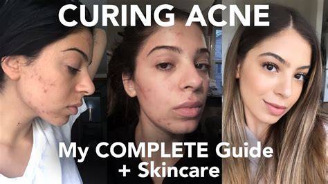 Curing Acne My Complete Guide Skincare Youtube