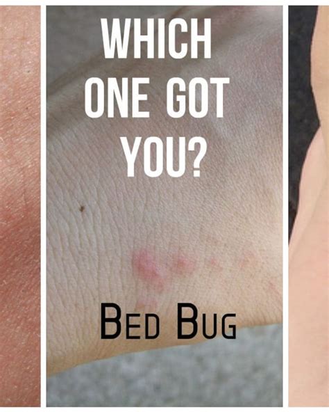 Bug Bites That Cause Swelling Youmemindbody Health And Wellness