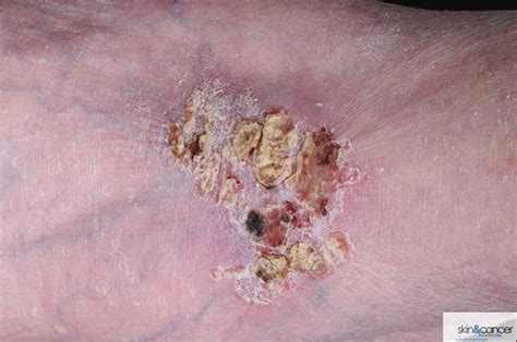 Cancer Squamous Cell Skin Cancer