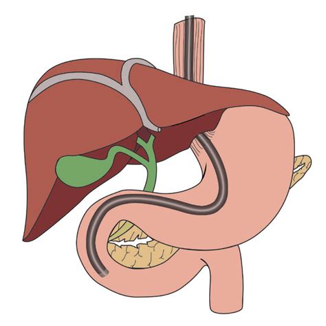 Ercp Endoscopic Retrograde Cholangio Pancreatography Patient