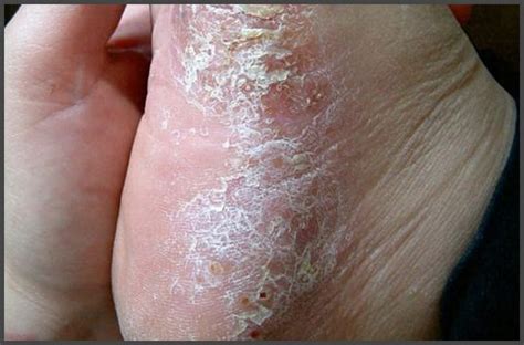 Psoriasis On Feet Pictures Psoriasis Expert