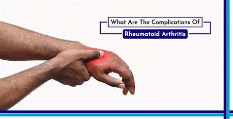 Rheumatoid Arthritis Complications Signs Symptoms And Prevention Mrmed