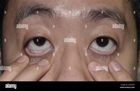 Pale Skin Of Asian Young Man Sign Of Anemia Pallor At Eyelid Stock