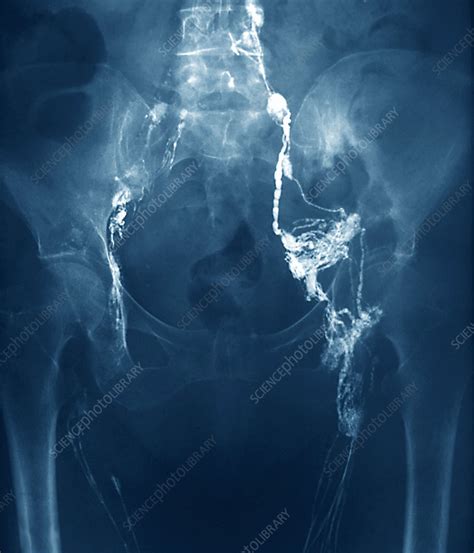 Secondary Lymph Gland Cancer X Ray Stock Image M8500653 Science