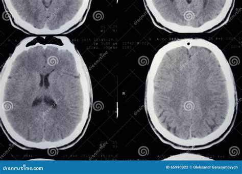 Ct Scan Of The Head Stock Photo Image Of Care Medical 65990022