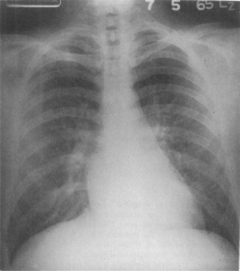 Mitral Stenosis Massive Pulmonary Hemorrhage And Emergency Valve