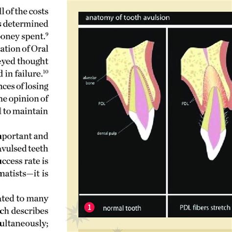 Anatomy Of Tooth Avulsion Note Pdl Cells Remaining On Root Download