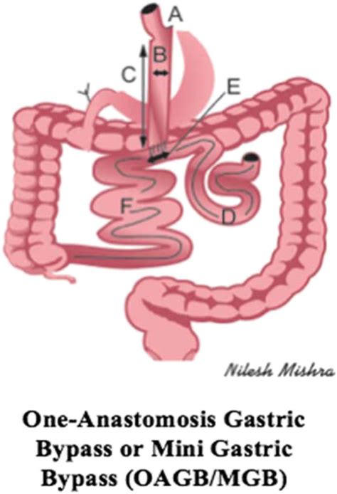 One Anastomosis Gastric Bypass Or Mini Gastric Bypass Oagbmgb