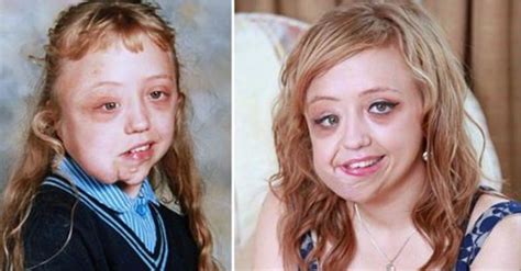 Girl With Facial Deformity Called Tumor Girl By Hateful Bullies Then