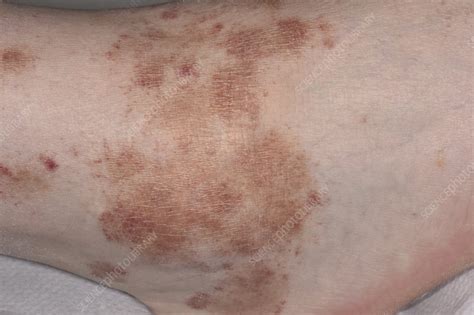 Rash Due To Drug Reaction Stock Image C0498217 Science Photo Library