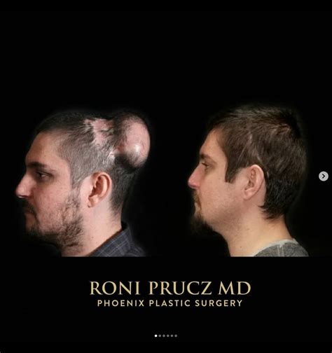 Scalp Reconstruction Phoenix Plastic Surgery