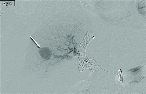 Conventional Angiography With Selective Catheterization Of The Right