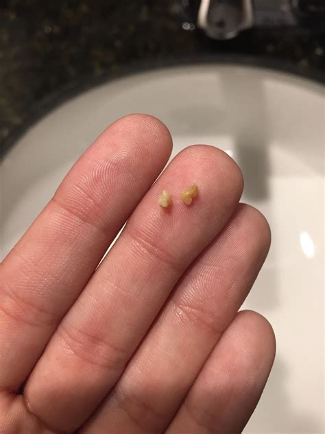 First Ever Tonsil Stones Coughed These Up The Other Day Rpopping