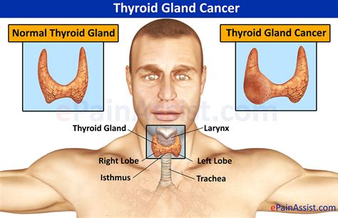 Thyroid Gland Cancercausessymptomstreatment Surgery Harmone
