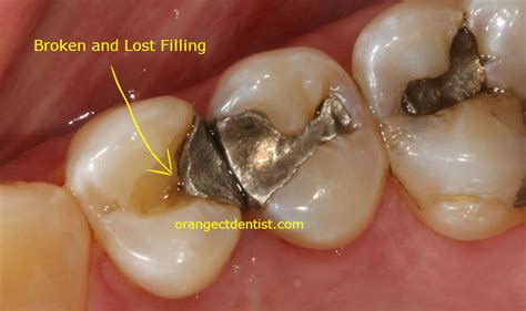 Lost Or Broken Filling Calcaterra Dentistry Orange Woodbridge Ct