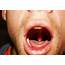 Swollen Uvula  Pictures Causes Symptoms Treatment
