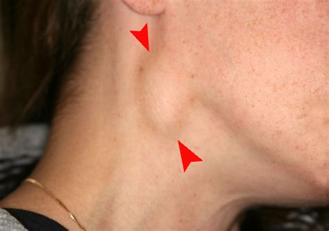 Cervical Lymphadenopathy Causes Diagnosis Treatment