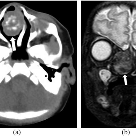 Lymphangioleiomyomatosis Lam In A Patient With Tuberous Sclerosis A