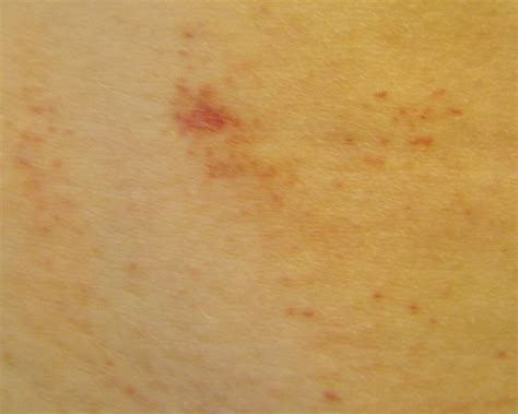 Small Red Spots On Skin Petechiae