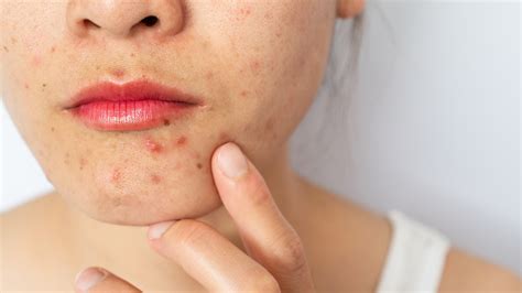 Im A Dermatologist Here Are The 4 Most Common Skin Conditions I Deal