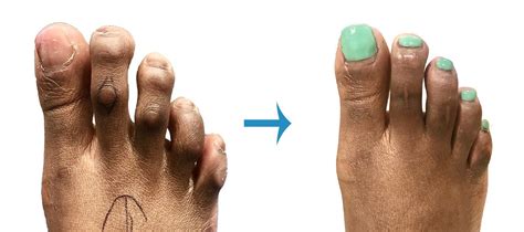 Cosmetic Toe Shortening Surgery