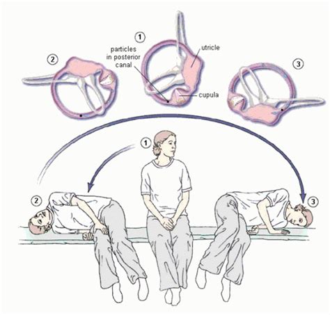 22 Epley Maneuver Patient Instructions 