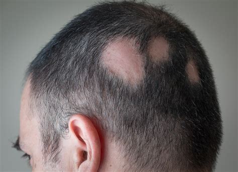 Alopecia Areata Hair Loss Treatment Causes And Cure Australia