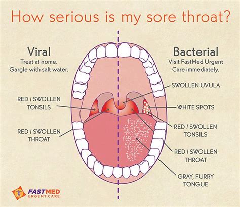 sore throat viral vs bacterial health resources medical good to know