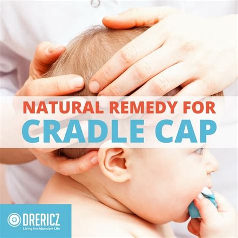 How To Get Rid Of Cradle Cap And Natural Remedy Cradle Cap Getting Rid