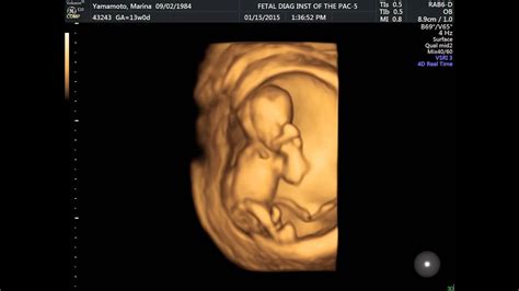 13 Week 4d Ultrasound Youtube