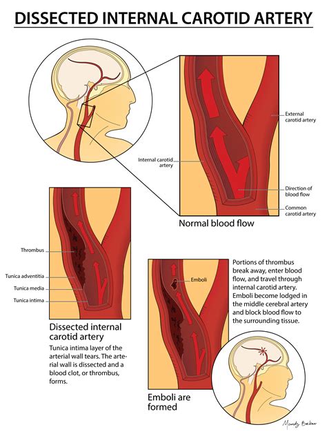 The internal carotid artery (latin: Is this on your radar ? Case # 1 : Answers - 60 Second EM