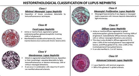 Pediatric Lupus Nephritis Brazilian Journal Of Nephrology Bjn