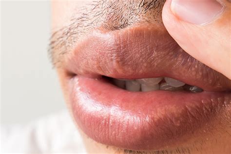 Fordyce Spots On The Lips Causes Symptoms Treatment Xhealth Portal